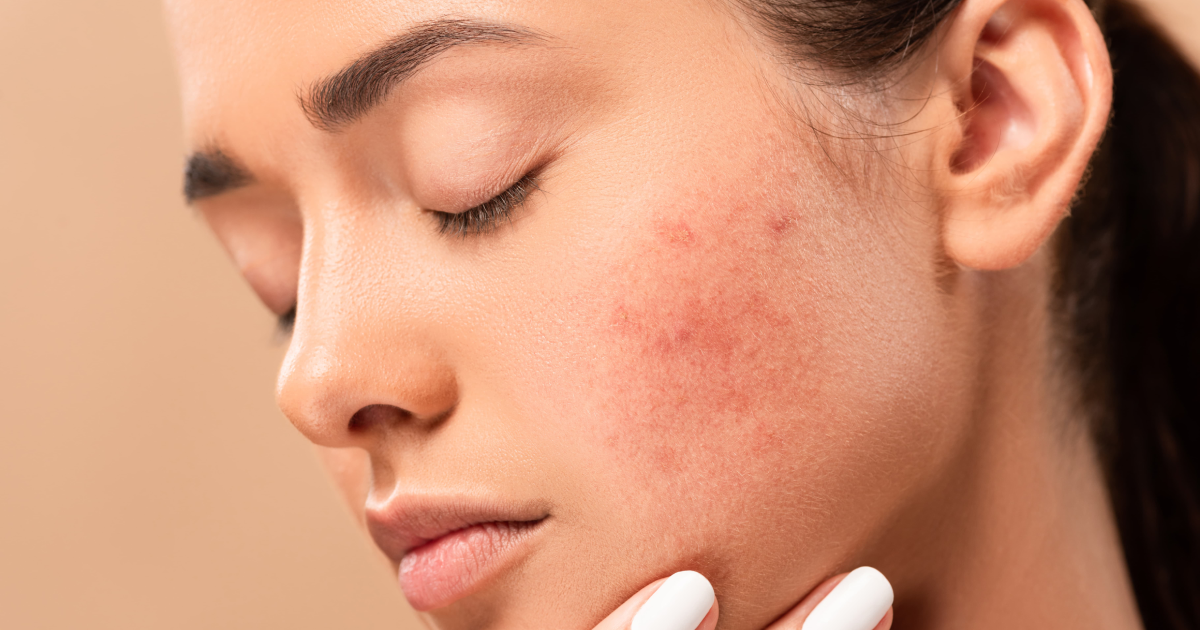 Woman with acne-prone skin considering acne treatment in Centennial, CO