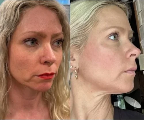 shape aesthetics before and after images b